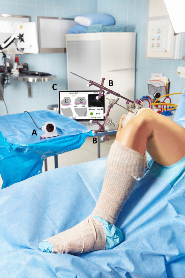 The use of imageless navigation to quantify cutting error in total knee arthroplasty.