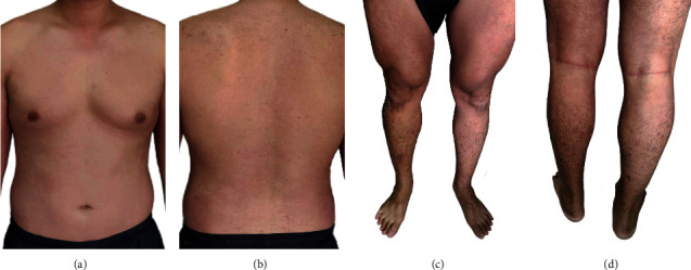 Erythroderma and Skin Desquamation in Paederus Dermatitis.