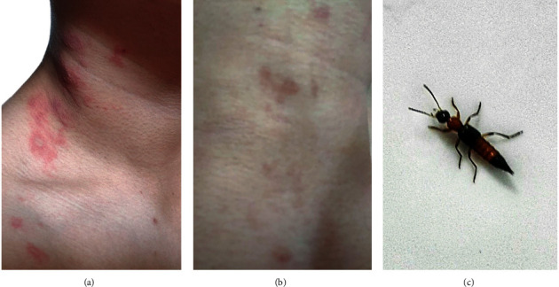 Erythroderma and Skin Desquamation in Paederus Dermatitis.