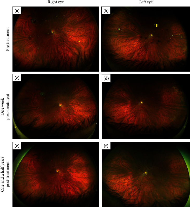 Multimodal Imaging of Waldenstrom Macroglobulinemia-Associated Hyperviscosity-Related Retinopathy Treated with Plasmapheresis.