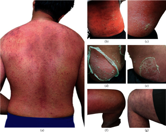 Erythroderma and Skin Desquamation in Paederus Dermatitis.