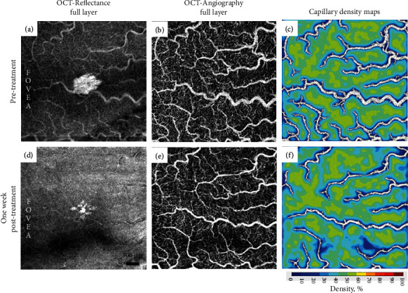 Multimodal Imaging of Waldenstrom Macroglobulinemia-Associated Hyperviscosity-Related Retinopathy Treated with Plasmapheresis.