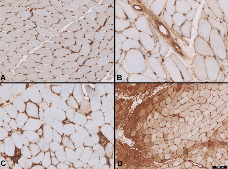 The Assessment of Major Histocompatibility Complex (MHC) Class-I Expression in Different Neuromuscular Diseases.