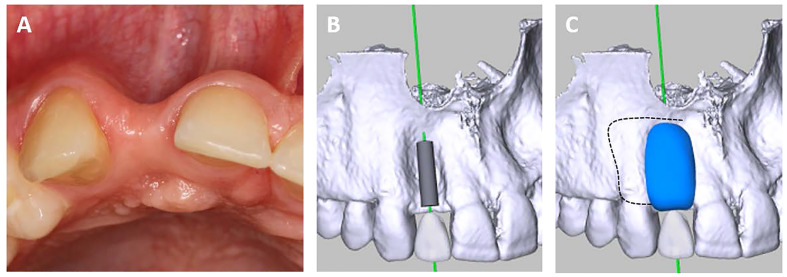 Volumetric Changes of a Customized Allogeneic Bone Block Measured by Two Image Matching Tools: Introduction of a Novel Assessment Technique for Graft Resorption.