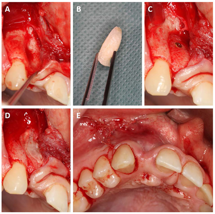 Volumetric Changes of a Customized Allogeneic Bone Block Measured by Two Image Matching Tools: Introduction of a Novel Assessment Technique for Graft Resorption.