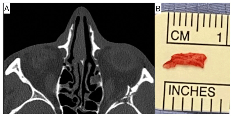 Acute Abducens Nerve Palsy in a Patient who Sustained Mechanical Trauma to the Orbit.