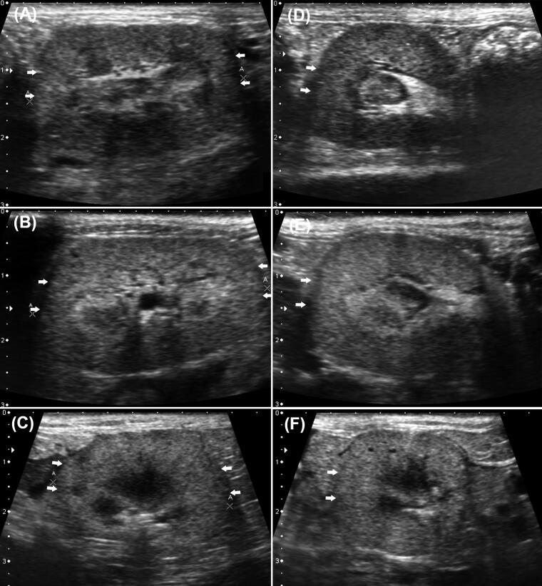 Absence of renal cortical anisotropic backscattering artifact in feline chronic kidney disease.