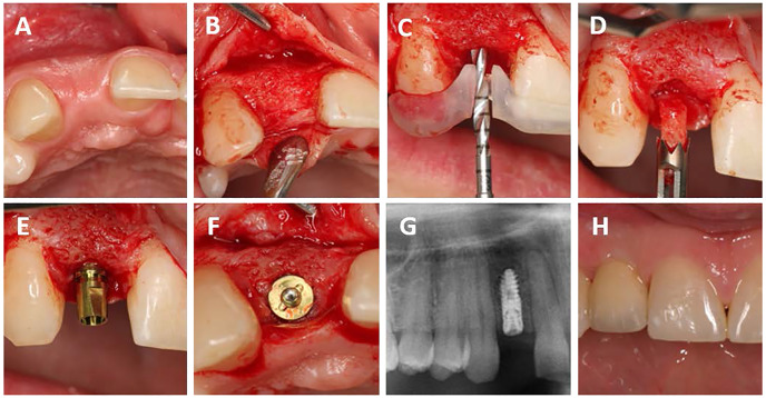 Volumetric Changes of a Customized Allogeneic Bone Block Measured by Two Image Matching Tools: Introduction of a Novel Assessment Technique for Graft Resorption.