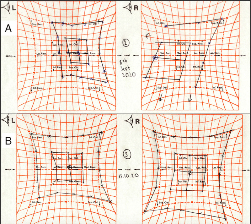 Acute Abducens Nerve Palsy in a Patient who Sustained Mechanical Trauma to the Orbit.