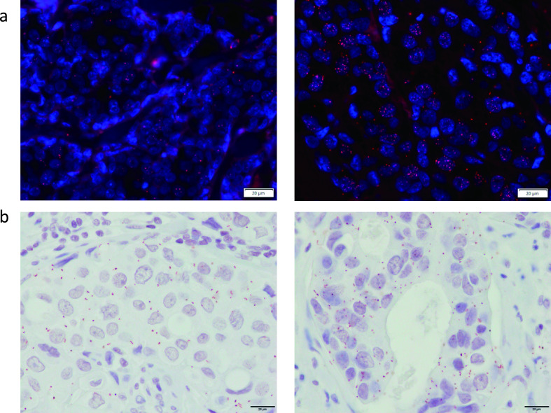 The Visualization of Protein-Protein Interactions in Breast Cancer: Deployment Study in Pathological Examination.