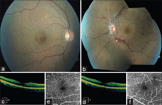 Central Retinal Vein Occlusion in a Young Healthy COVID-19 Patient: A Case Report and Literature Review.