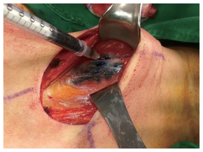 Utility of sentinel lymph node biopsy in papillary thyroid microcarcinoma.