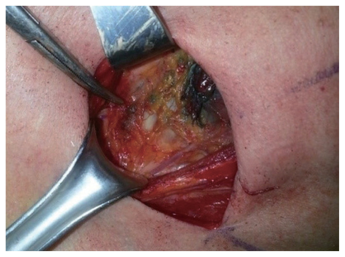 Utility of sentinel lymph node biopsy in papillary thyroid microcarcinoma.