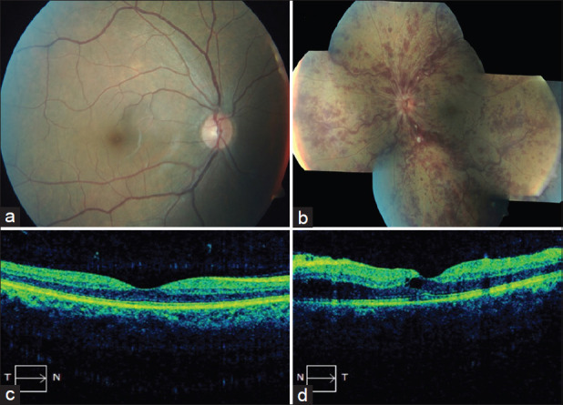 Central Retinal Vein Occlusion in a Young Healthy COVID-19 Patient: A Case Report and Literature Review.