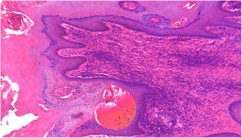 Prevalence and histopathological characterization of Masai Giraffe (<i>Giraffa camelopardalis tippelskirchi</i>) skin disease in Tarangire-Manyara ecosystem, Northern Tanzania.