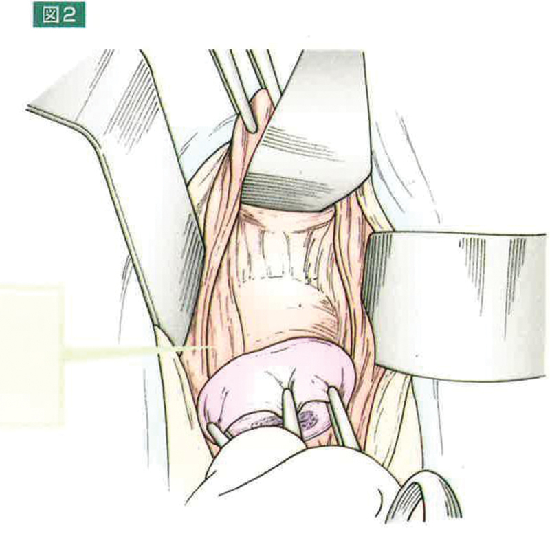 Radical Vaginal Trachelectomy.