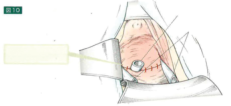 Radical Vaginal Trachelectomy.