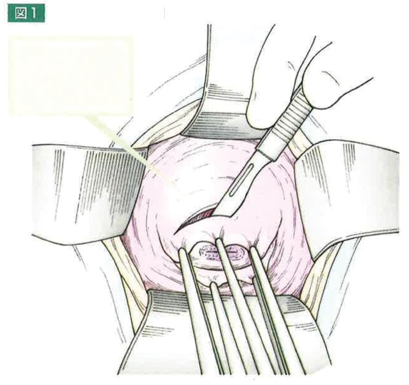 Radical Vaginal Trachelectomy.