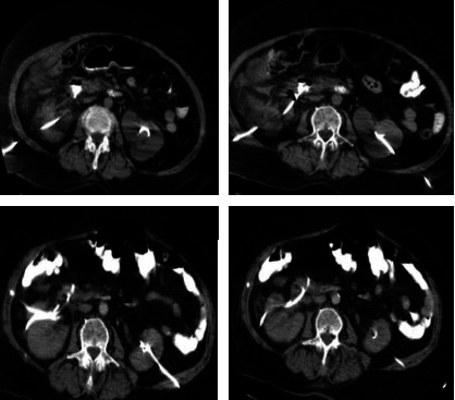 Conservative Management of the Duodenal Injury during Percutaneous Nephrostomy Placement: A Few and Far between Complications of the Urological Literature.