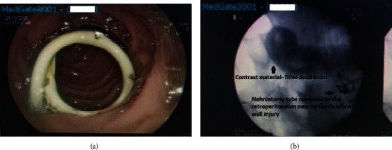 Conservative Management of the Duodenal Injury during Percutaneous Nephrostomy Placement: A Few and Far between Complications of the Urological Literature.