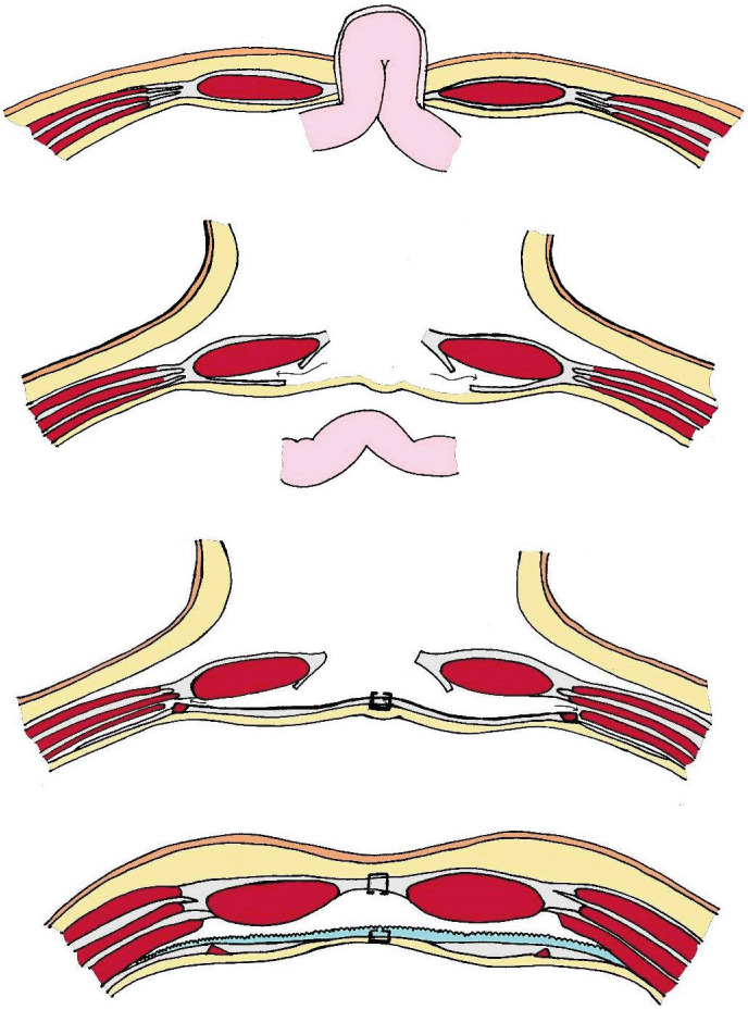 Simultaneous Complex Incisional Hernia Repair and Bariatric Surgery for Obese Patients: a Case Series of a Single-Center Early Experience.