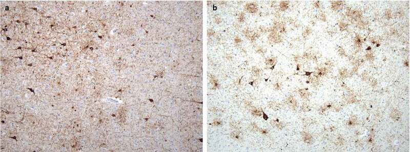 PART and ARTAG tauopathies at a relatively young age as a concomitant finding in sporadic Creutzfeldt-Jakob disease.