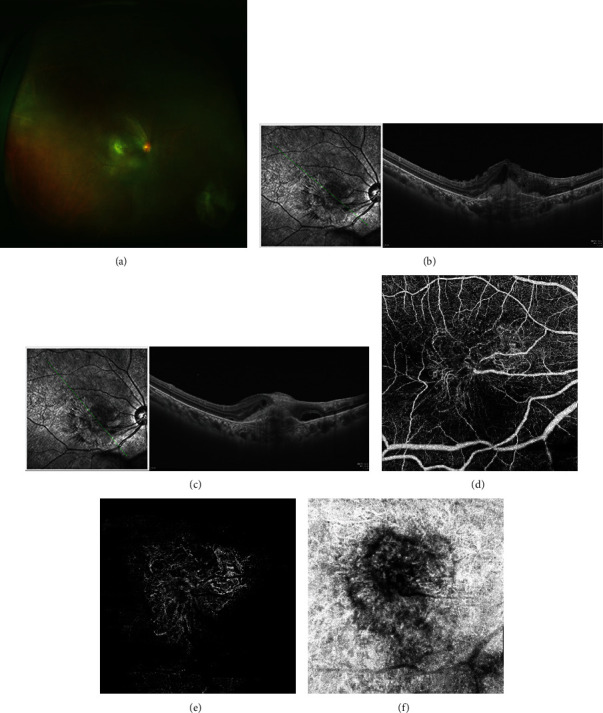 A Case of Chorioretinitis with Retinal Angiomatous Proliferation.