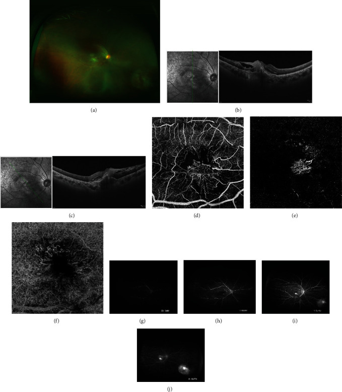 A Case of Chorioretinitis with Retinal Angiomatous Proliferation.