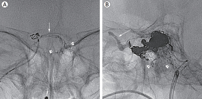 Transvenous injection of n-butyl 2-cyanoacrylate to obliterate the pathologic cavernous sinus as a salvage technique for incompletely obliterated complex cavernous sinus dural arteriovenous fistula after transvenous coil embolization.