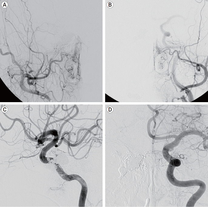 Transvenous injection of n-butyl 2-cyanoacrylate to obliterate the pathologic cavernous sinus as a salvage technique for incompletely obliterated complex cavernous sinus dural arteriovenous fistula after transvenous coil embolization.