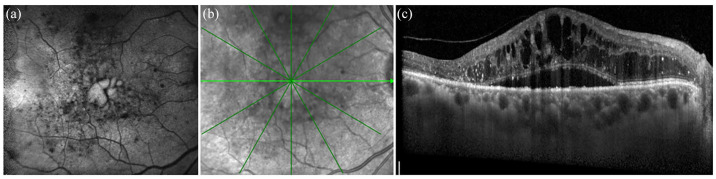 The role of inflammation and neurodegeneration in diabetic macular edema.