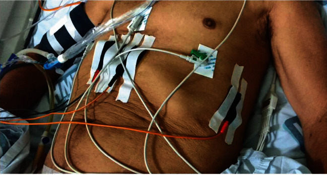 Immediate Hemodynamic Responses to Transcutaneous Electrical Diaphragmatic Stimulation in Critically Ill Elderly Patients.