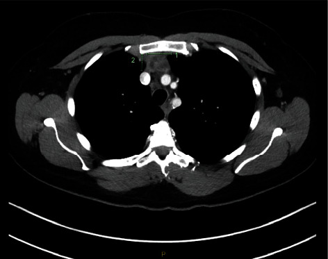 A Pregnancy Case of Primary Mediastinal Large B Cell Lymphoma with Superior Vena Cava Syndrome.