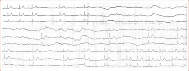 Is the Adenosine Test Obsolete in the Clinical Assessment of Syncope of Unknown Origin?