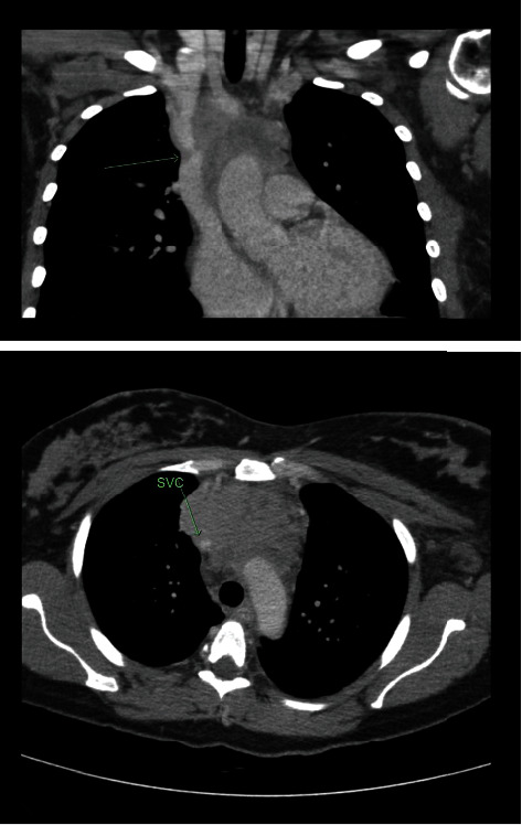 A Pregnancy Case of Primary Mediastinal Large B Cell Lymphoma with Superior Vena Cava Syndrome.