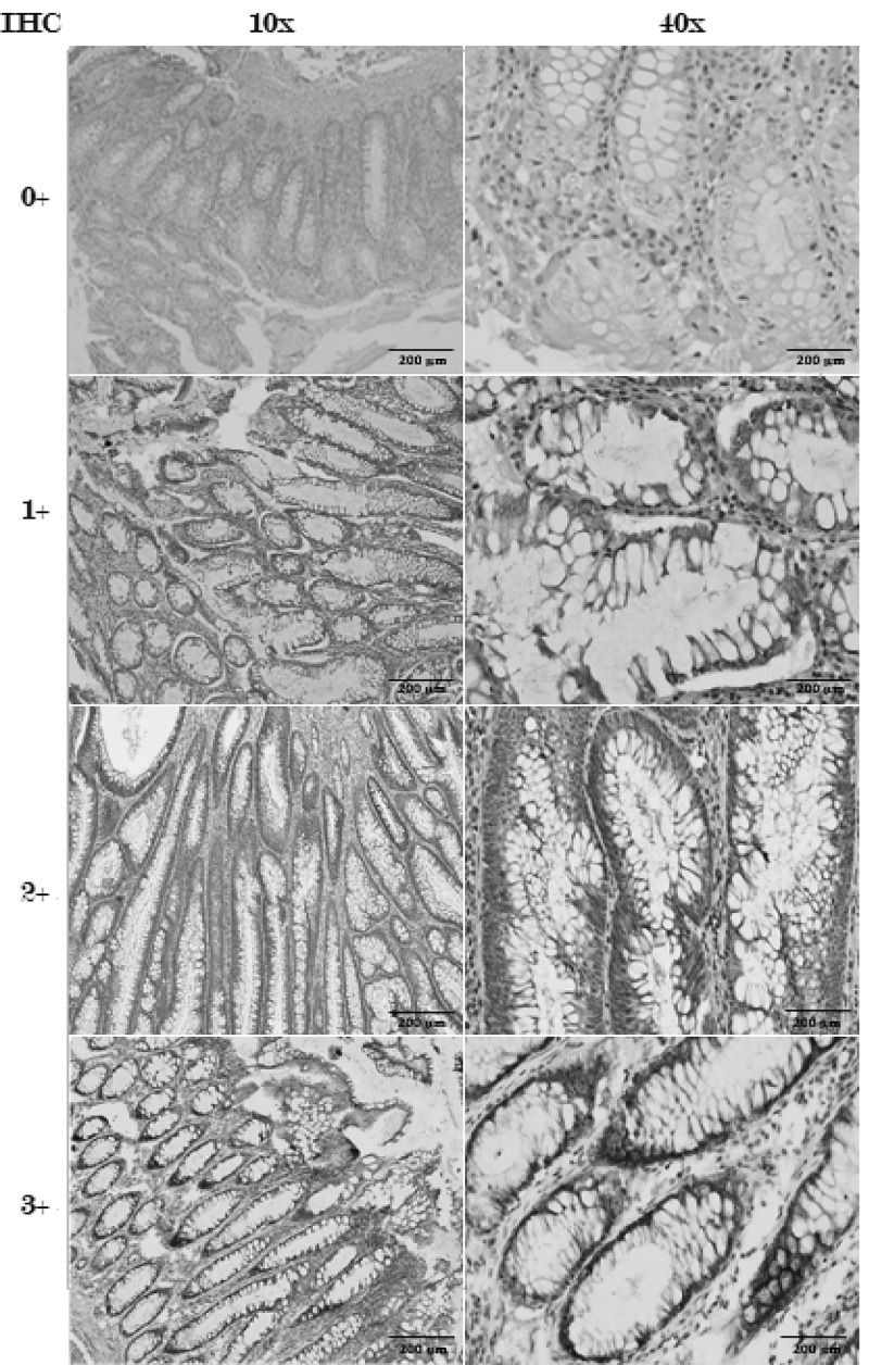 HER2 overexpression is a putative diagnostic and prognostic biomarker for late-stage colorectal cancer in North African patients.