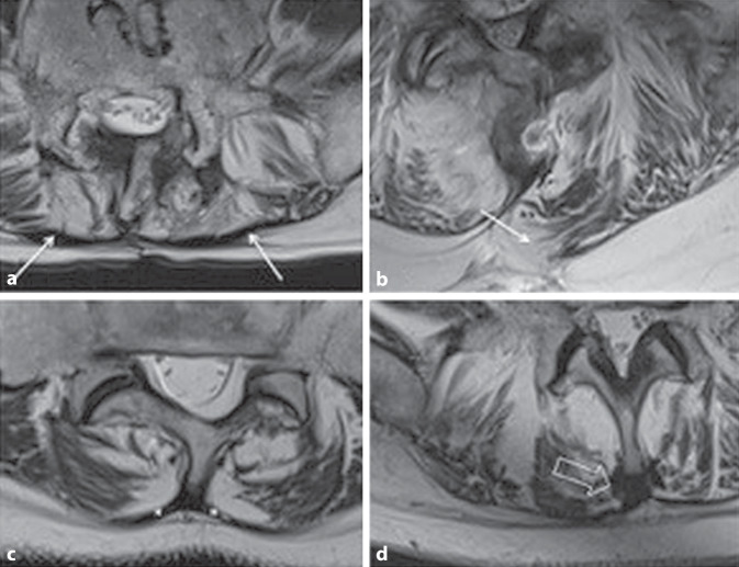 Visualization of the epimysium and fascia thoracolumbalis at the lumbar spine using MRI.