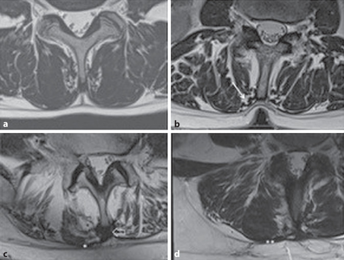 Visualization of the epimysium and fascia thoracolumbalis at the lumbar spine using MRI.