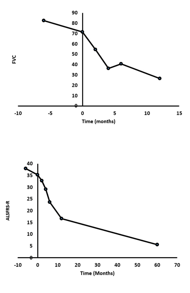 Safety and Efficacy of Allogeneic Adipose Tissue Mesenchymal Stromal Cells in Amyotrophic Lateral Sclerosis Patients, Single-Center, Prospective, Open-Label, Single-Arm Clinical Trial, Long-Term Follow-up.