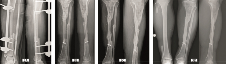 Classification of vascularized fibular flap hypertrophy based on X-ray evaluation.
