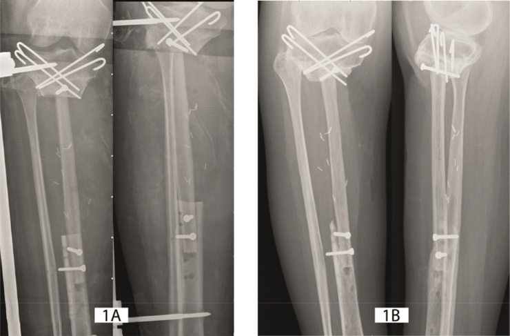 Classification of vascularized fibular flap hypertrophy based on X-ray evaluation.
