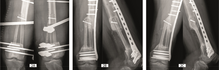 Classification of vascularized fibular flap hypertrophy based on X-ray evaluation.