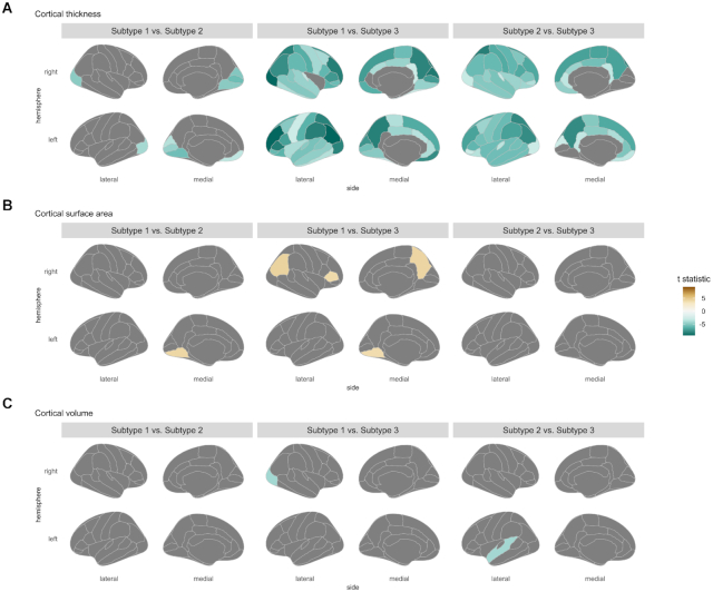 Distinct neuroanatomic subtypes in antipsychotic-treated patients with schizophrenia classified by the predefined classification in a never-treated sample.