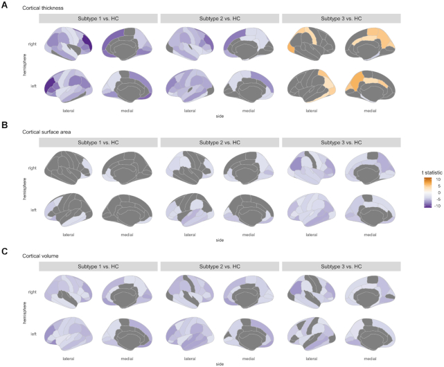 Distinct neuroanatomic subtypes in antipsychotic-treated patients with schizophrenia classified by the predefined classification in a never-treated sample.