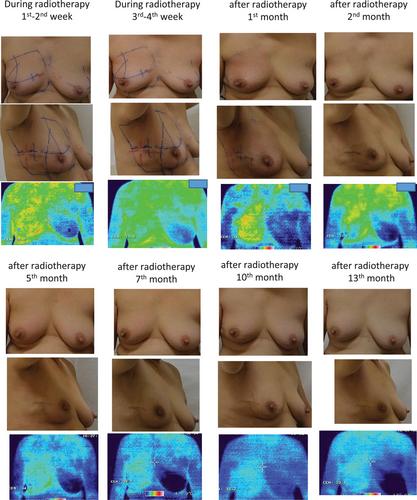 Long-term analysis of irradiated skin after breast-conserving surgery in breast cancer patients using noninvasive imaging