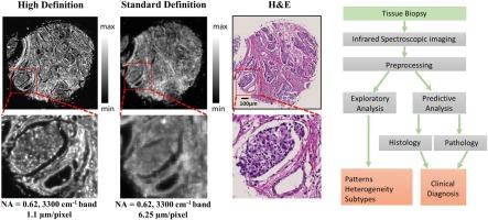 Breast cancer histopathology using infrared spectroscopic imaging: The impact of instrumental configurations