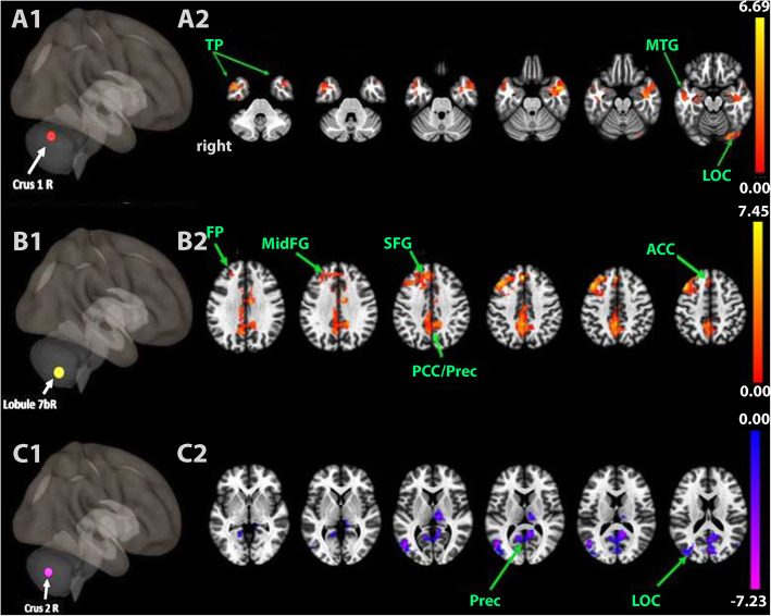 Cerebellar transcranial direct current stimulation reconfigurates static and dynamic functional connectivity of the resting-state networks.