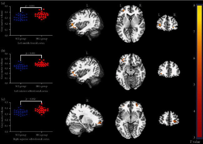 Altered Topological Properties of Grey Matter Structural Covariance Networks in Complete Thoracic Spinal Cord Injury Patients: A Graph Theoretical Network Analysis.