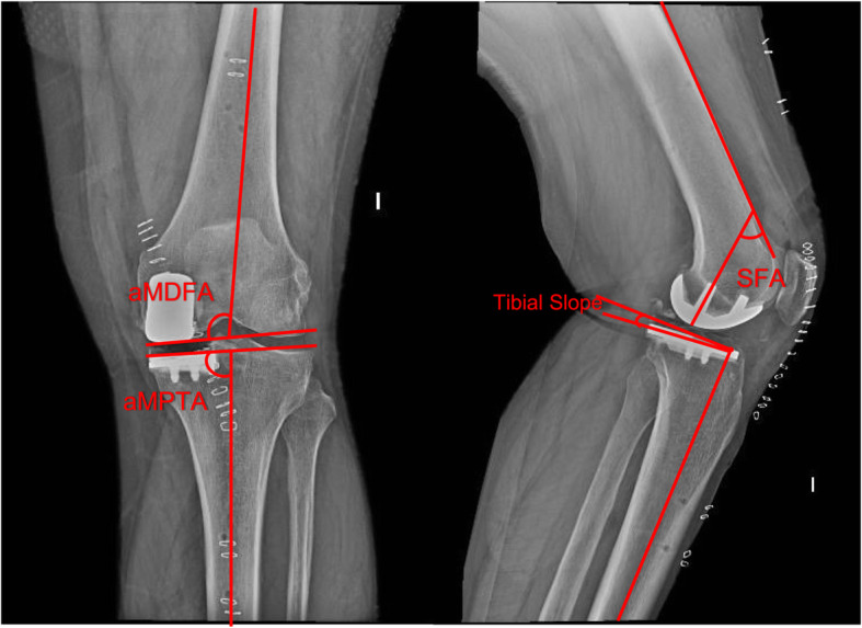 Robotic-assisted vs conventional surgery in medial unicompartmental knee arthroplasty: a clinical and radiological study.