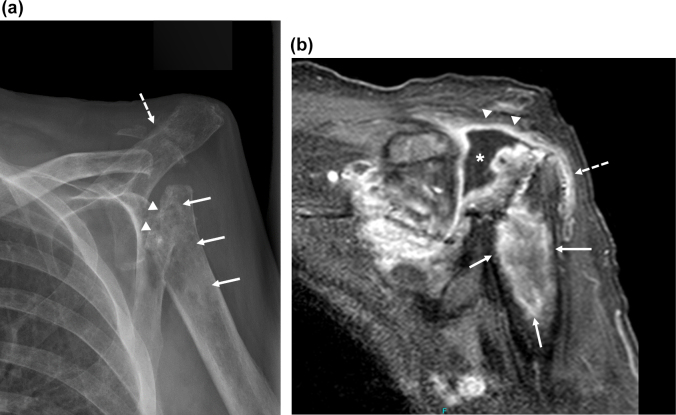 <i>Mycobacterium bovis</i> BCG osteoarticular infection complicating immune therapy for bladder cancer: a case report.